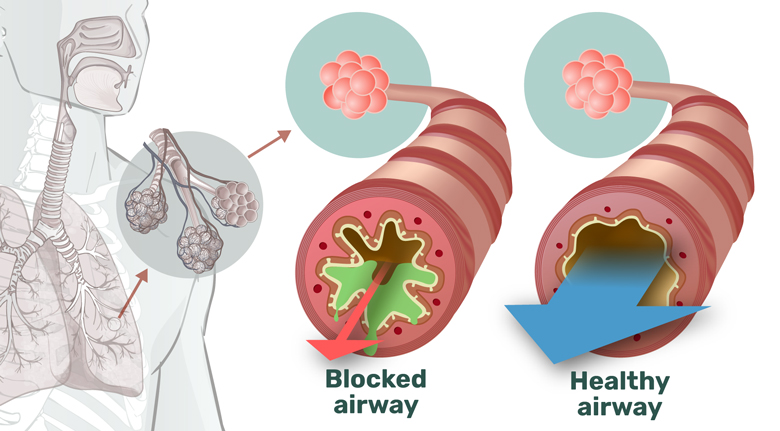 how mucus clearance devices work