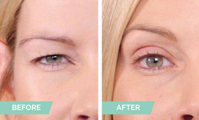 How to Lift Hooded Eyelids?