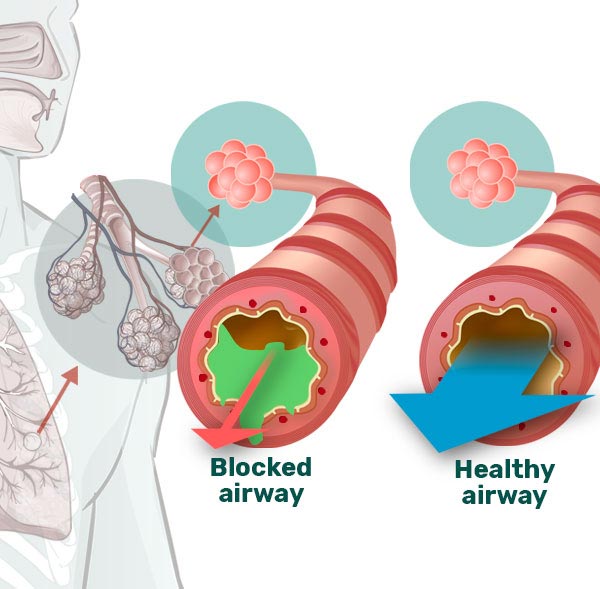 the breather blocked and healthy airways