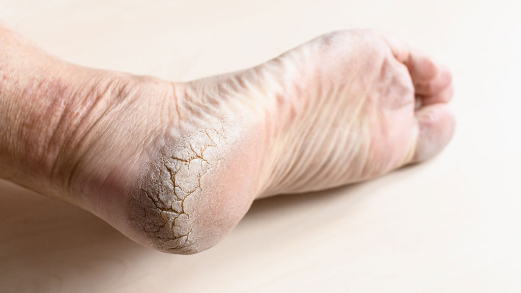 dead dry cracked skin on heel of male foot