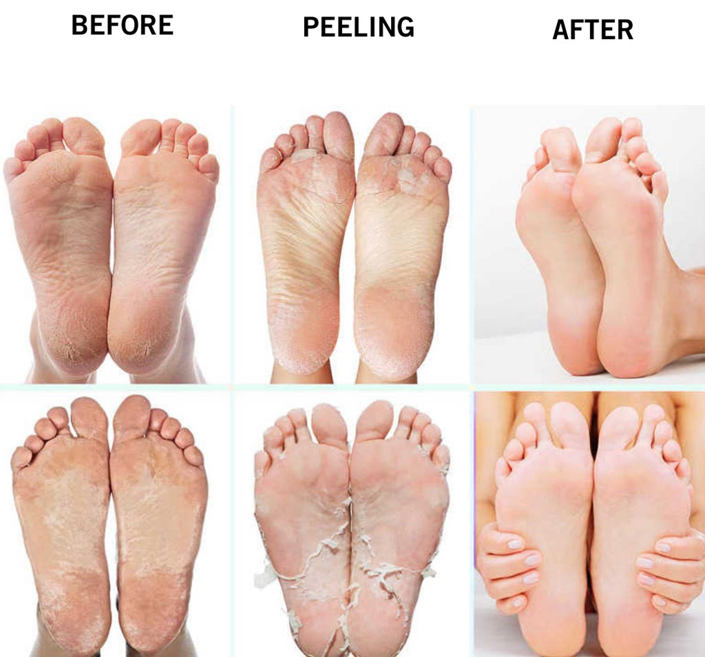 foot peeling mask before and after