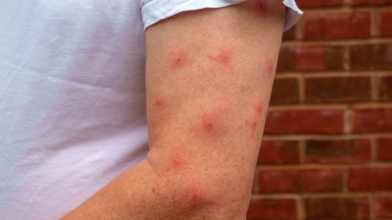 Allergic Reactions
