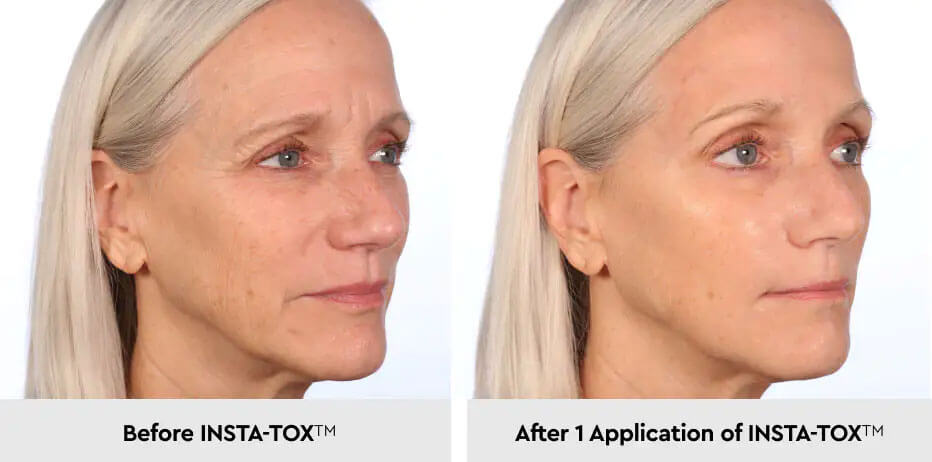 insta-tox-before-after-adv