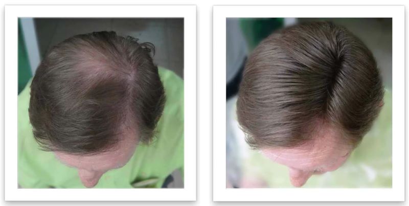 caboki before and after 2