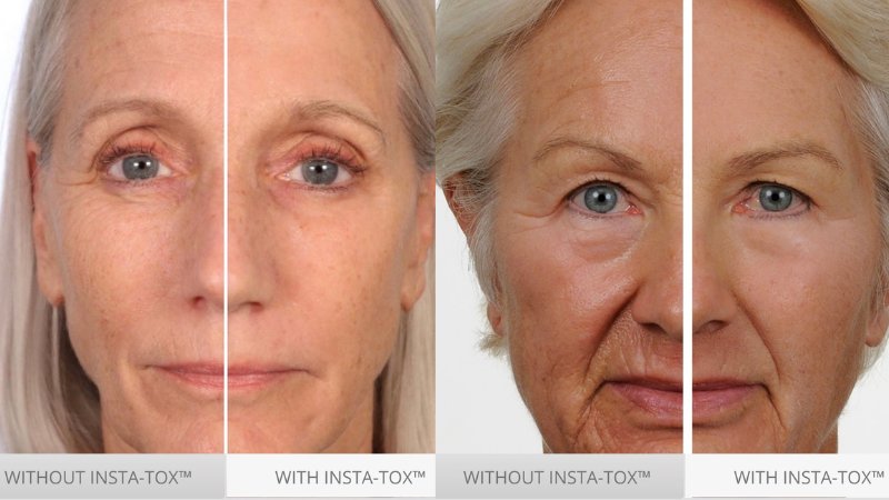 insta-tox before and after under eye bags and puffines