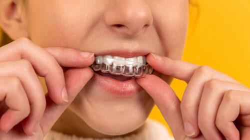 How to Clean Retainers