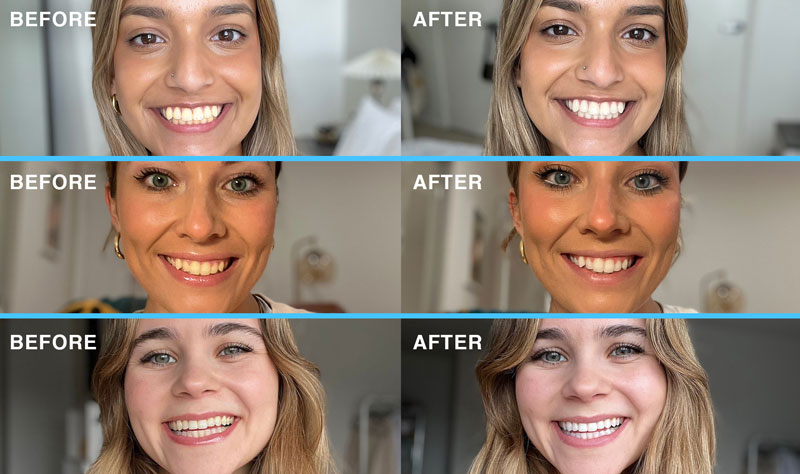 before-and-after-results-of-using-laughland-teeth-whitening-kit