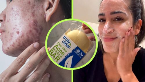 Truly Clear Acne Bar Review - 5 Minute Treatment That Actually Works and It's Surprisingly Affordable